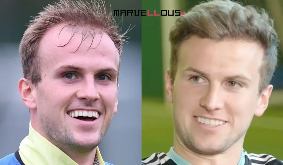 Celebrity Hair Transplants Before And After Celebrity Hair Transplants Before And After