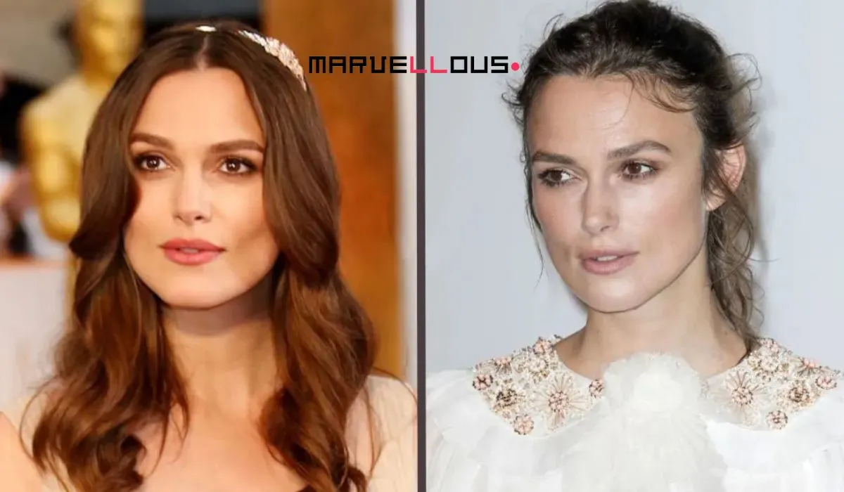 Celebrity Hair Transplants Before And After Celebrity Hair Transplants Before And After
