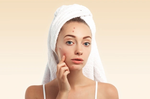 Transform Your Skin: Acne Solutions for Sensitive Types